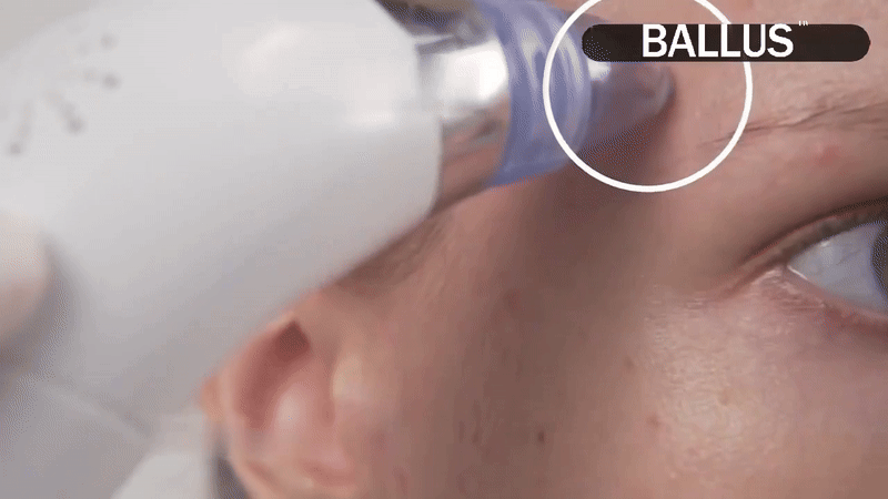 Blackhead Remover Pore Vacuum Cleaner — 5 Suction Levels & 4 Probes